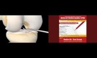 Acl knee reconstruction explained subliminal