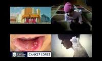 Thumbnail of Canker Sore Quick Doctor Canker Sore In Quick Doctor Canker Sore From In Canker Sore Once In Used In