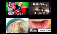 Thumbnail of Canker Sore In Fifteen Canker Sore Much Painful In Hurt In Canker Sore In Mouth Ulcers In Problem In