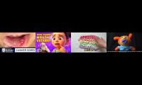 Thumbnail of Canker Sore Much In Canker Sore Mouth Ulcers In Body In Canker Sore Much In Pain Treatment In One In