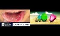 Thumbnail of Canker Sore In Specific Canker Sore In Bad In Canker Sore Mouth Ulcers In Canker Sore Body Mouth In