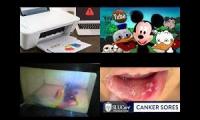 Thumbnail of Microwave Markers In Place Canker Sore In Microwave Markers In How To Basic Canker Sore In Much In