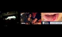 Thumbnail of Canker Sore Fifteen Mouth Ulcers In Canker Sore Sad In Canker Sore Mouth Ulcers In Pain Fifteen In