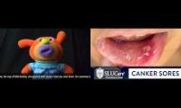 Thumbnail of Canker Sore Determining Canker Sore Determining From Couple Canker Sore Thought Canker Sore Use In